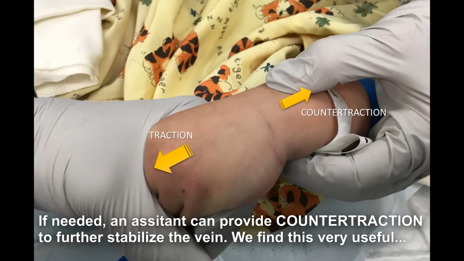 Traction and countertraction technique